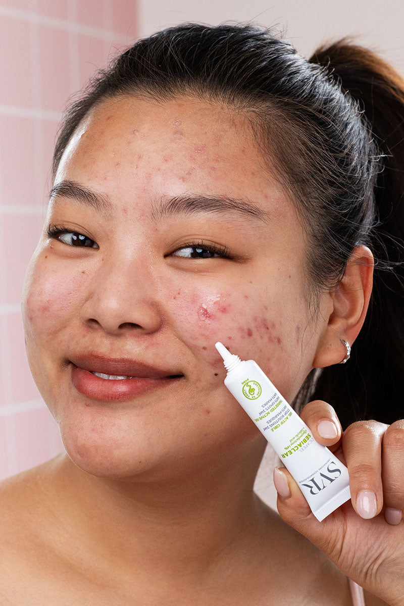 The Guide to Dermatological Acne Treatments: Finding Your Best Facial Care Routine
