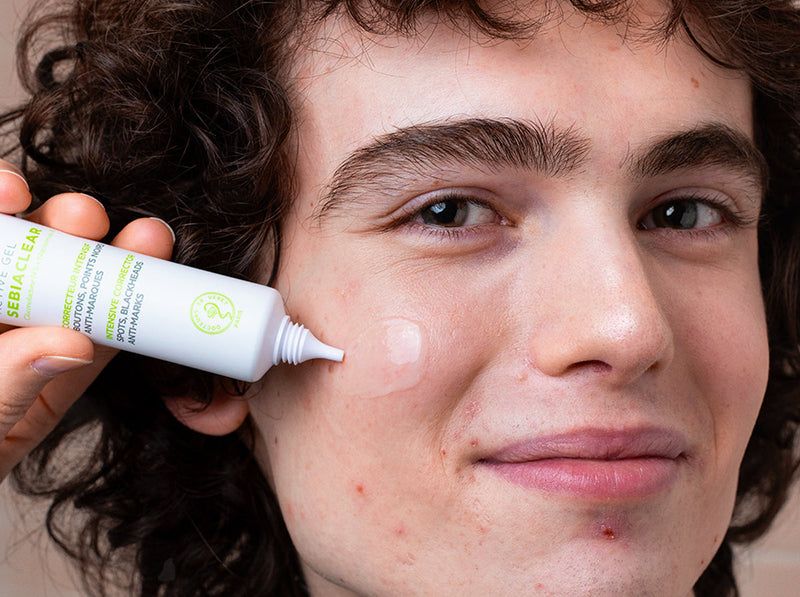 Young person applying a clear acne treatment gel from a white tube onto their cheek to manage skin breakouts.