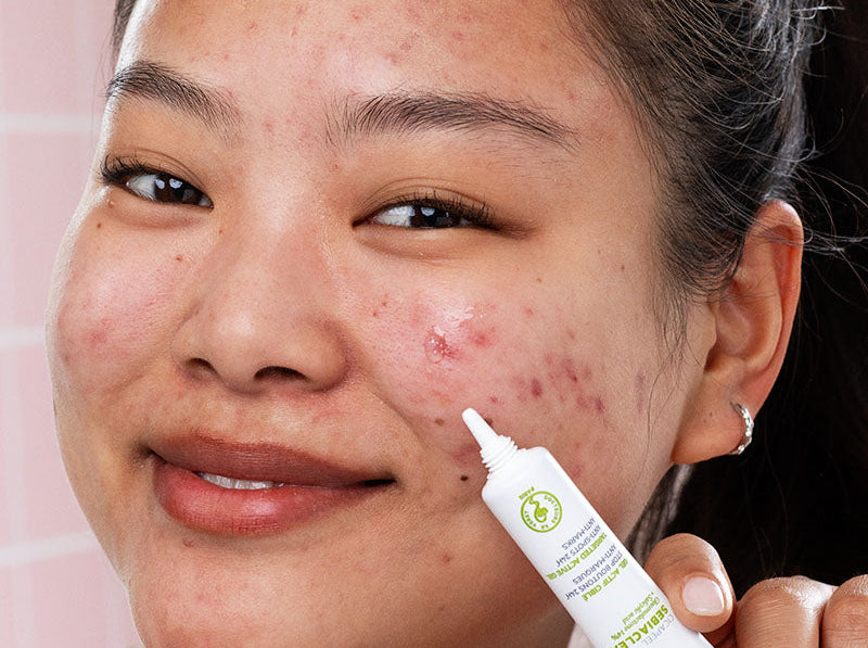 Young woman applying SVR Sebiaclear acne treatment gel to a breakout on her cheek.
