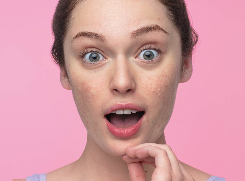 Sebiaclear Gel Cream for Acne & Blackhead-Prone Skin - Reduces ...